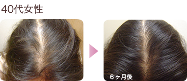髪のお悩みをお持ちの女性方限定 女性専用発毛治療スタートプラン