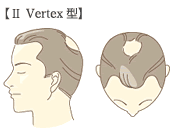 II型 Vertex 型