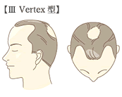 III型 Vertex 型